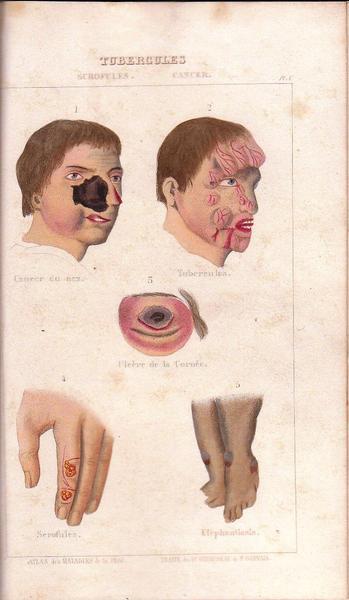 1841 Traité Des Maladies Vénériennes de Giraudeau de St.-gervais